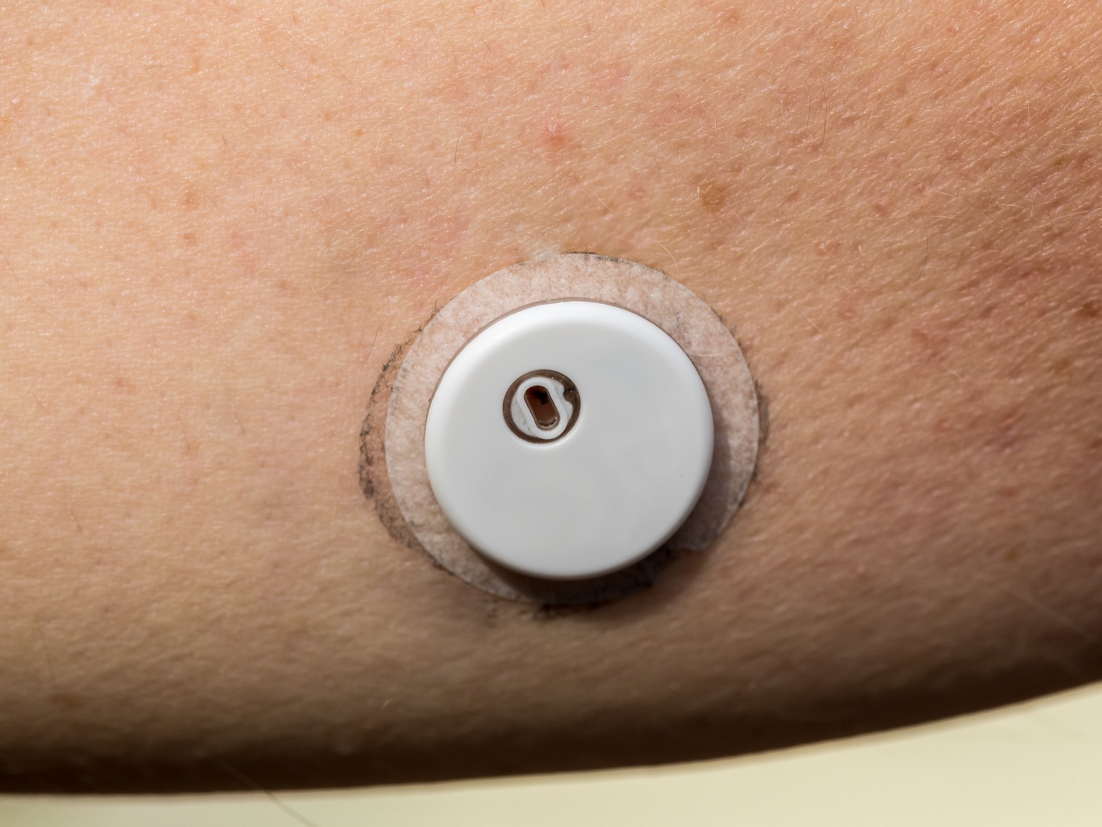 Szenzor a karon, valós idejű vércukor-monitorozás